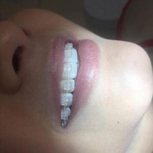 Aparelho Estético Safira Coc Odontologia
